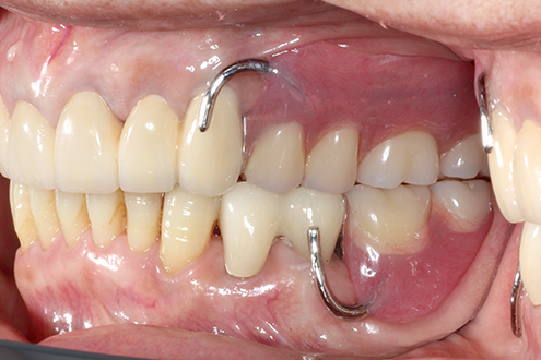 入れ歯治療の症例 正面